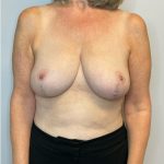 Breast Reduction Before & After Patient #2981