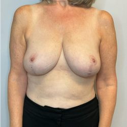 Breast Reduction Before & After Patient #2981