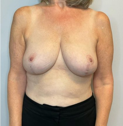 Breast Reduction Before & After Patient #2981