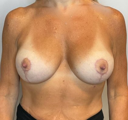 Breast Augmentation Before & After Patient #2982