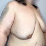 Breast Lift Before & After Patient #2949