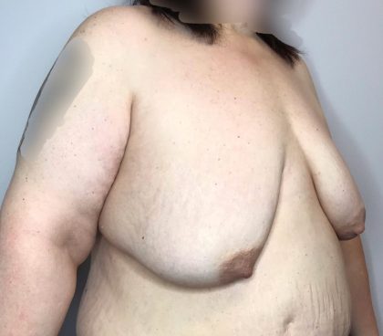 Breast Lift Before & After Patient #2949