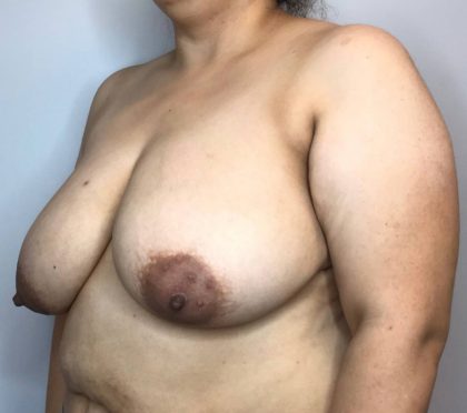 Breast Reduction Before & After Patient #3002