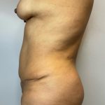 Brazilian Butt Lift Before & After Patient #2908