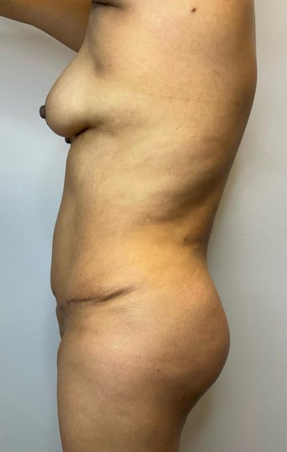 Brazilian Butt Lift Before & After Patient #2908