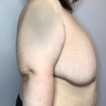 Breast Lift Before & After Patient #2949