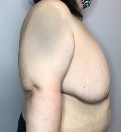 Breast Lift Before & After Patient #2949