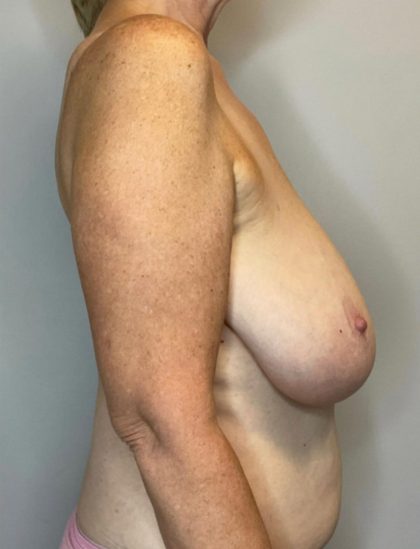 Breast Reduction Before & After Patient #2981