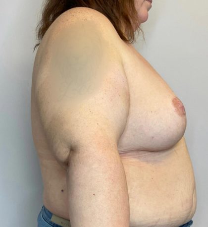 Breast Lift Before & After Patient #2949