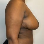 Breast Reduction Before & After Patient #2959