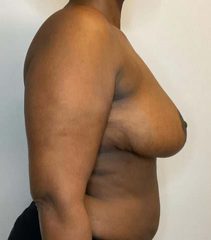 Breast Reduction Before & After Patient #2959