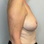 Breast Reduction Before & After Patient #2981