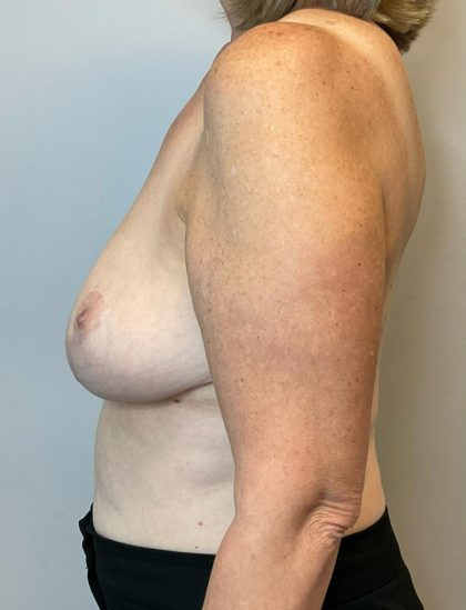 Breast Reduction Before & After Patient #2981