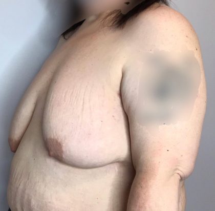 Breast Lift Before & After Patient #2949