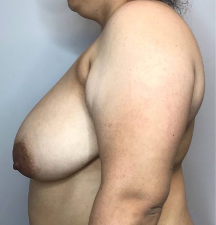 Breast Reduction Before & After Patient #3002